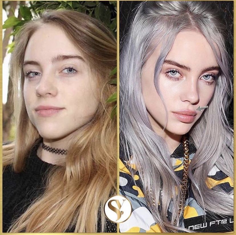 Did Billie Eilish Undergo Plastic Surgery Including Boob Job, Nose Job